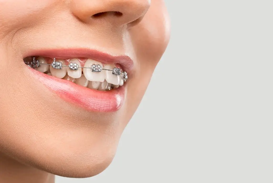 Sonrisa con ortodoncia metálica en los dientes superiores