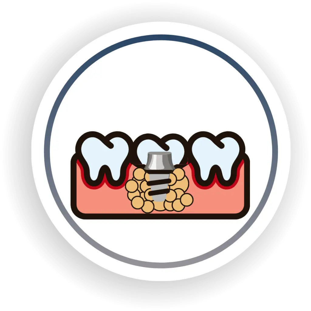 Se coloca la corona provisional o definitiva atornillada o cementada sobre tus implantes dentales