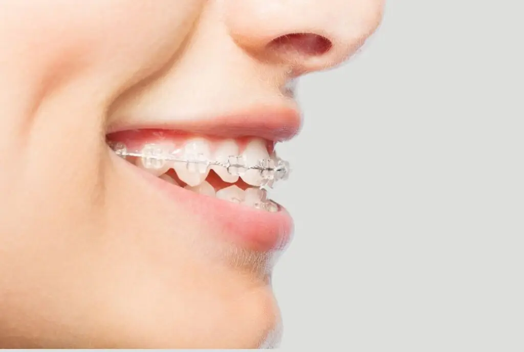 Brackets de Zafiro casi imperceptibles en paciente con ortodoncia en ambas arcadas