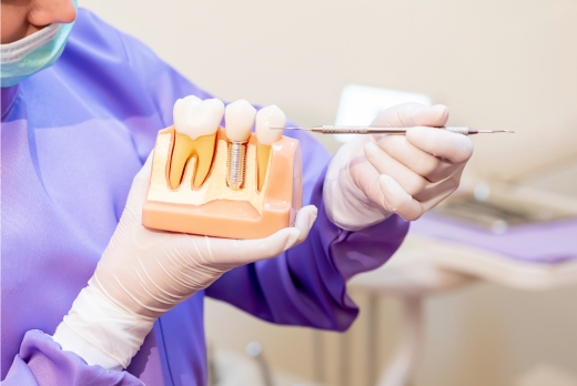 EL odontologo sontiene un modelo para explicar la diferencia entre un diente natural y un diente rehabilitado con implantes dentales