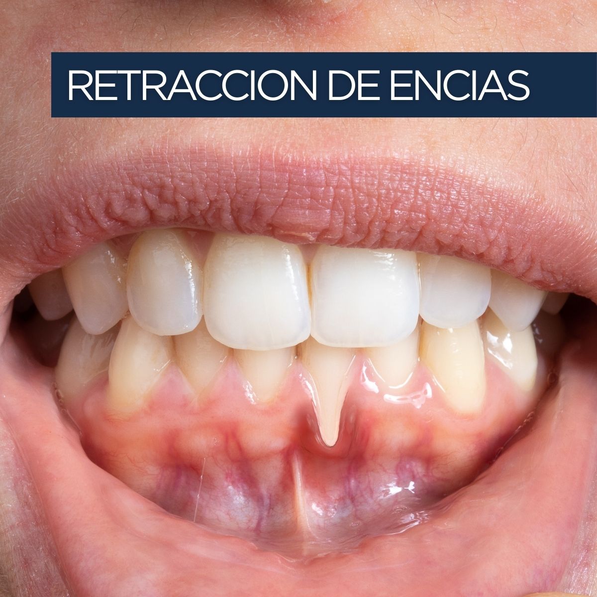 Retracción de encías como signo de enfermedad periodontal