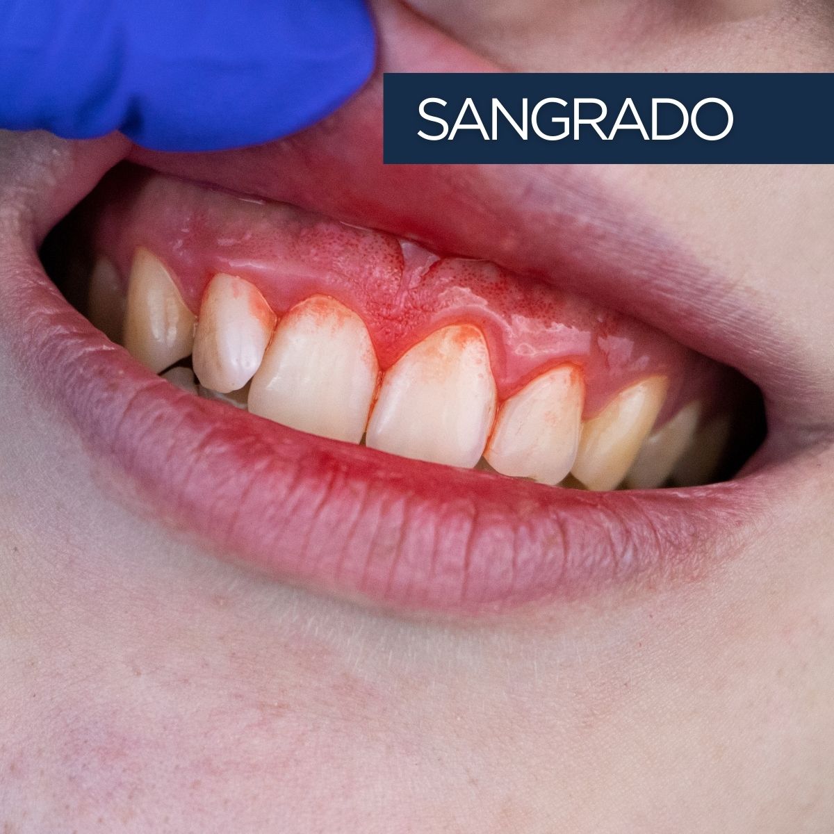 Encías inflamadas con sangrado por enfermedad periodontal