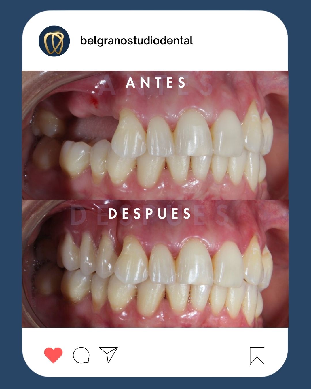 Antes y después de tratamiento de estética dental en Belgrano Studio Dental