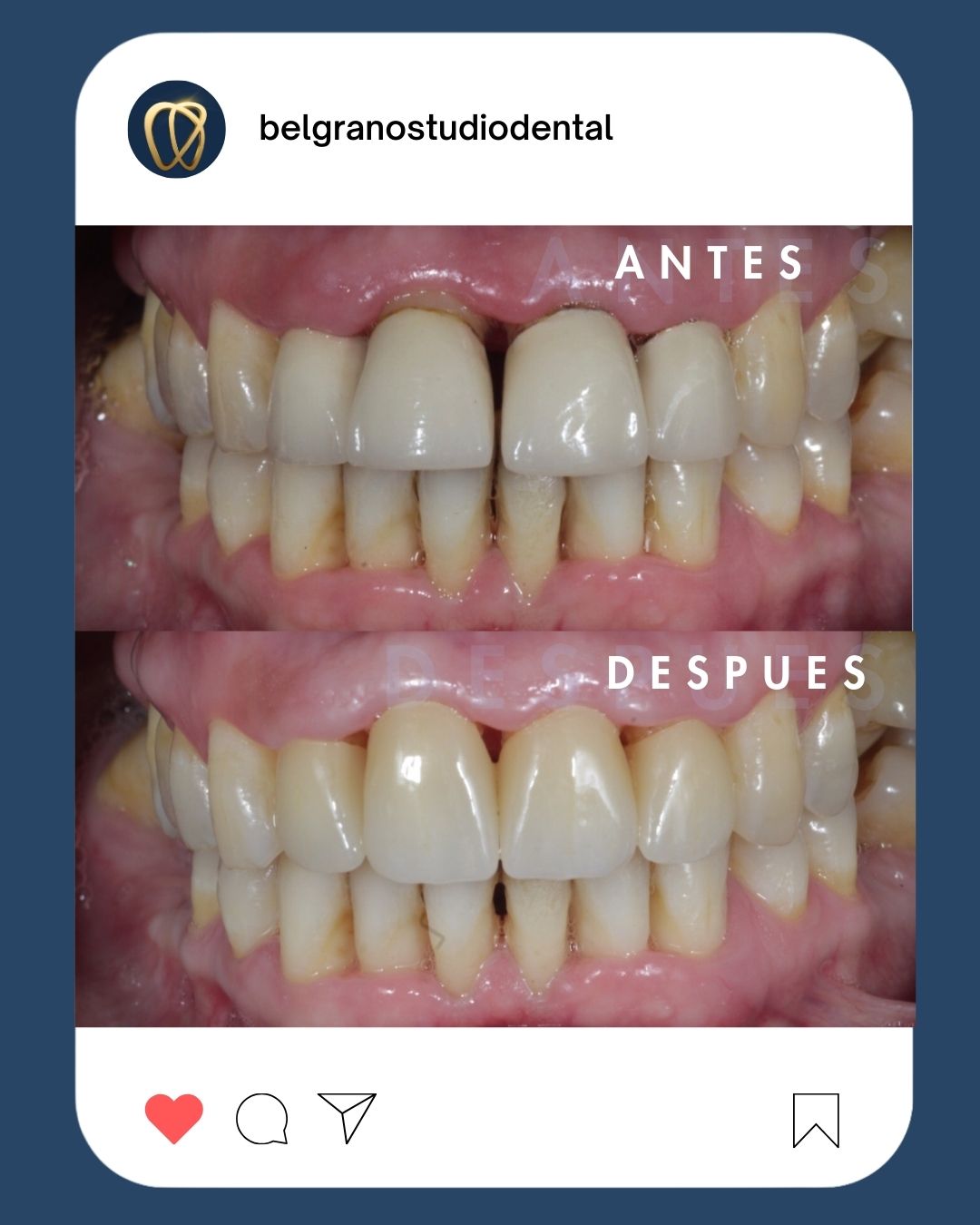 Antes y después de tratamiento de estética dental en Belgrano Studio Dental