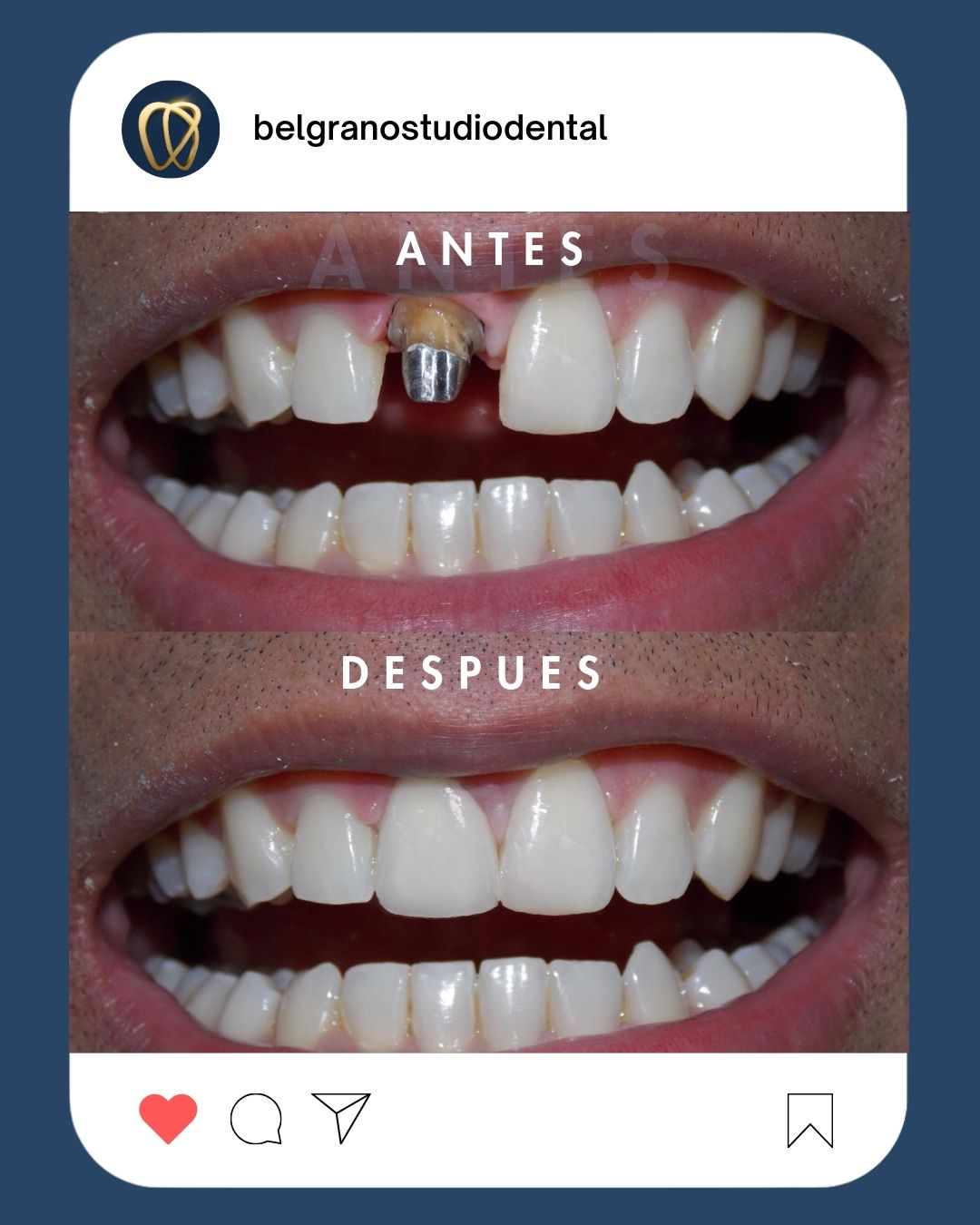 Antes y después de tratamiento de estética dental en Belgrano Studio Dental