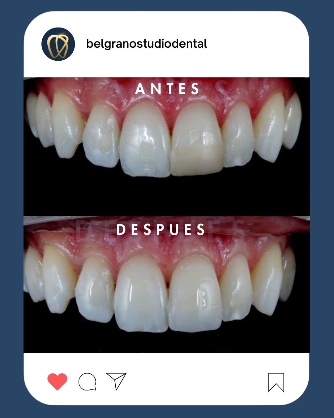 Antes y después de tratamiento de estética dental en Belgrano Studio Dental