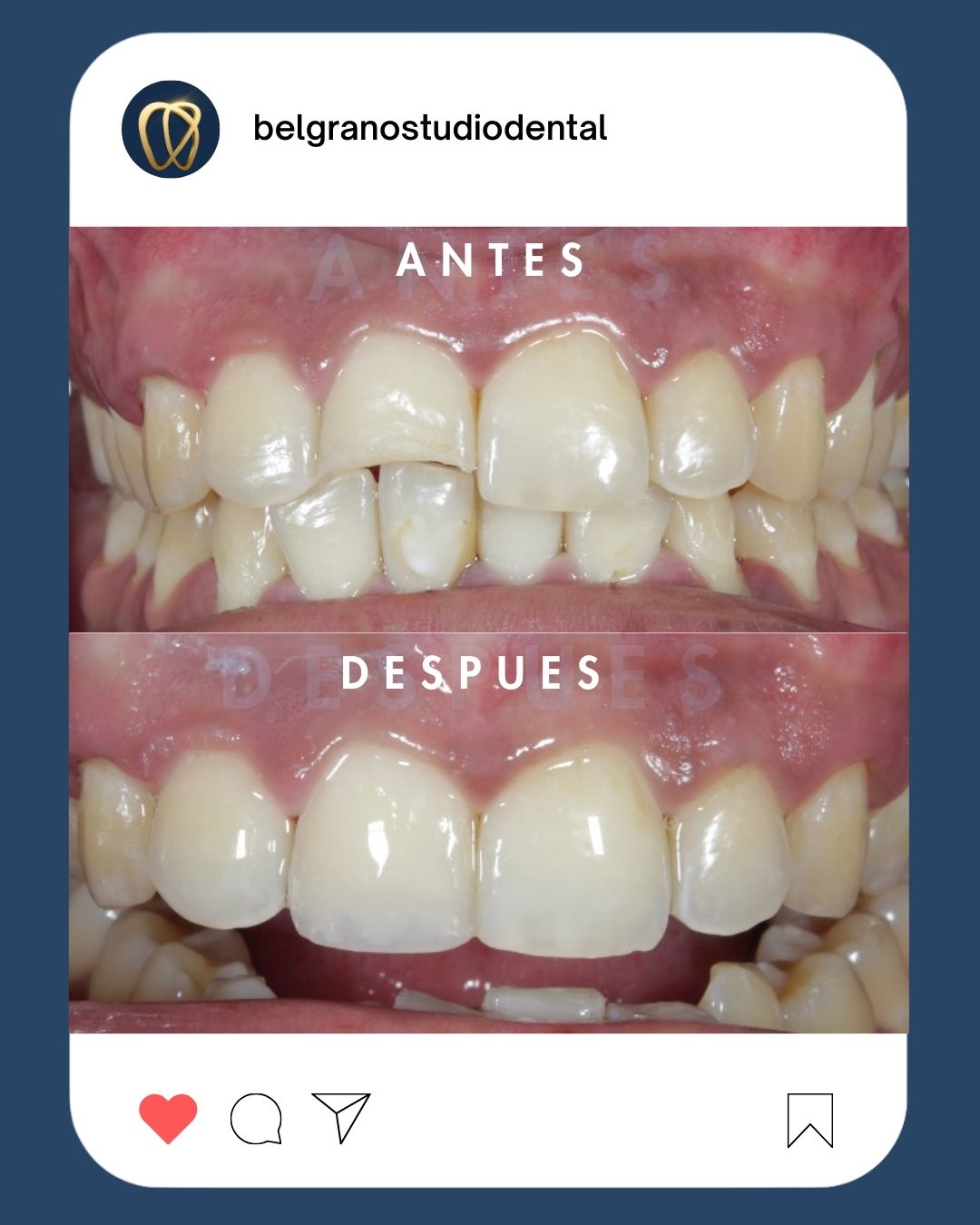 Antes y después de tratamiento de estética dental en Belgrano Studio Dental