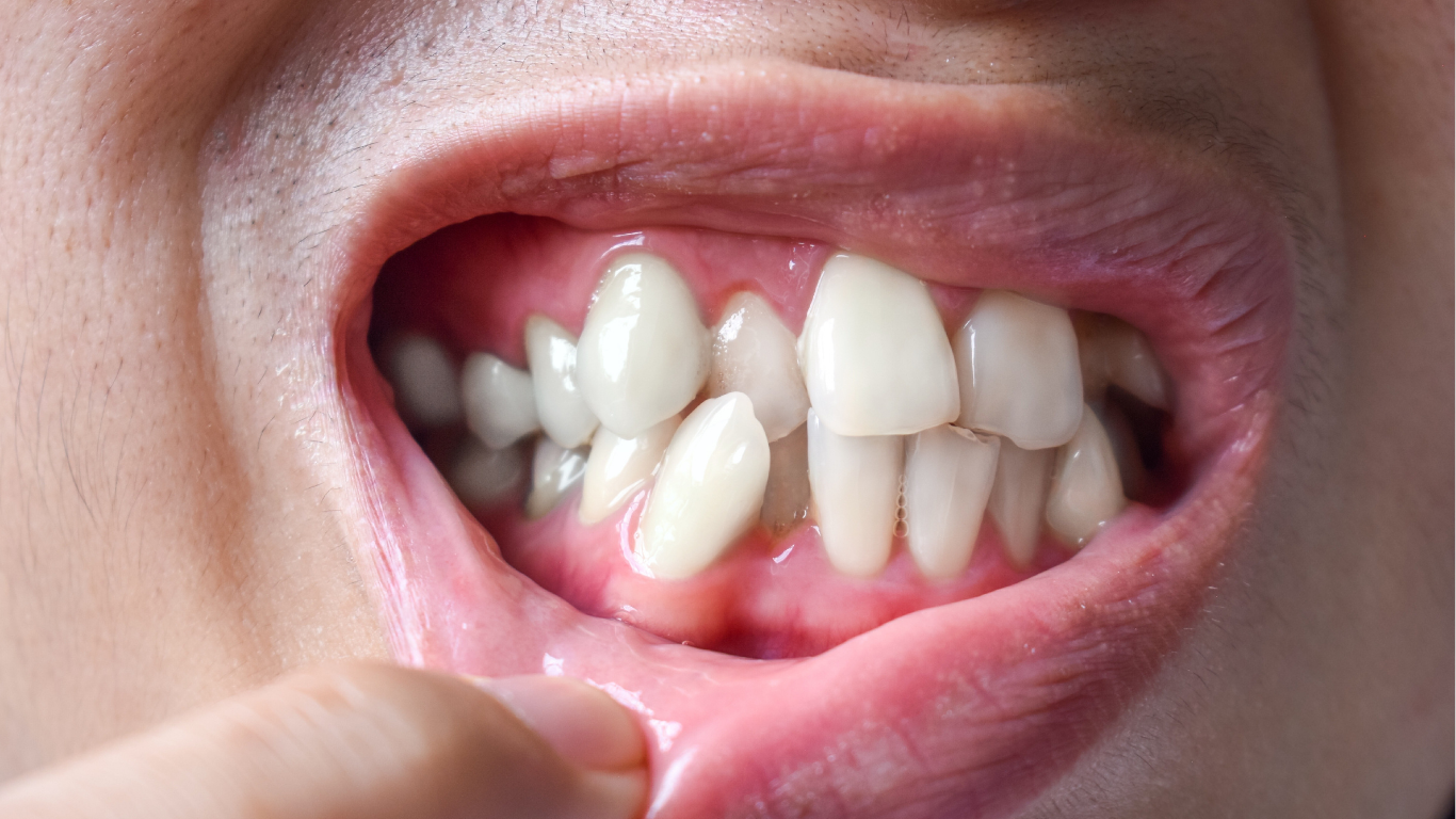 Apiñamiento dental con dientes desalineados que requieren tratamiento de ortodoncia