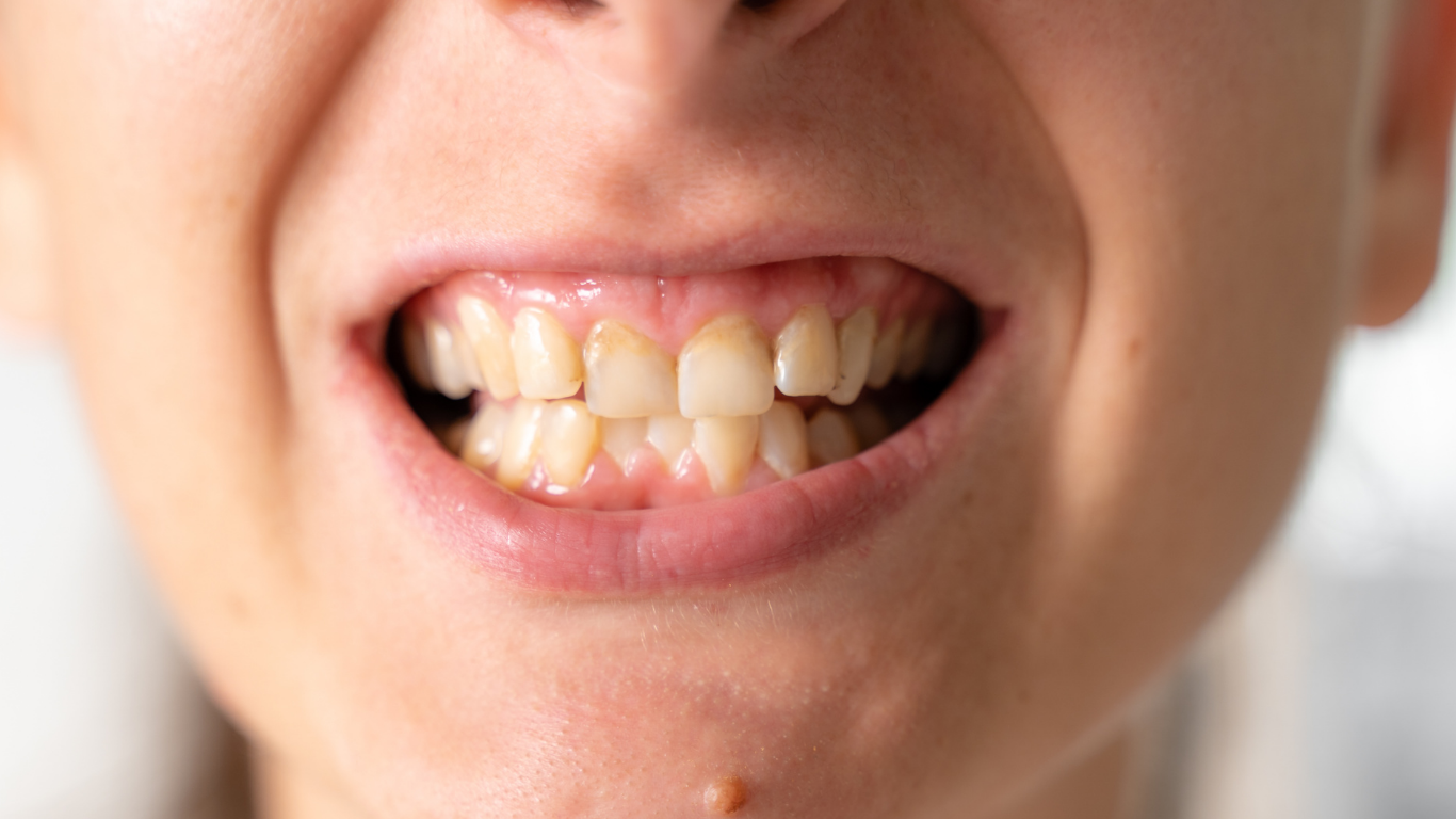 Apiñamiento dental con dientes desalineados que requieren tratamiento de ortodoncia