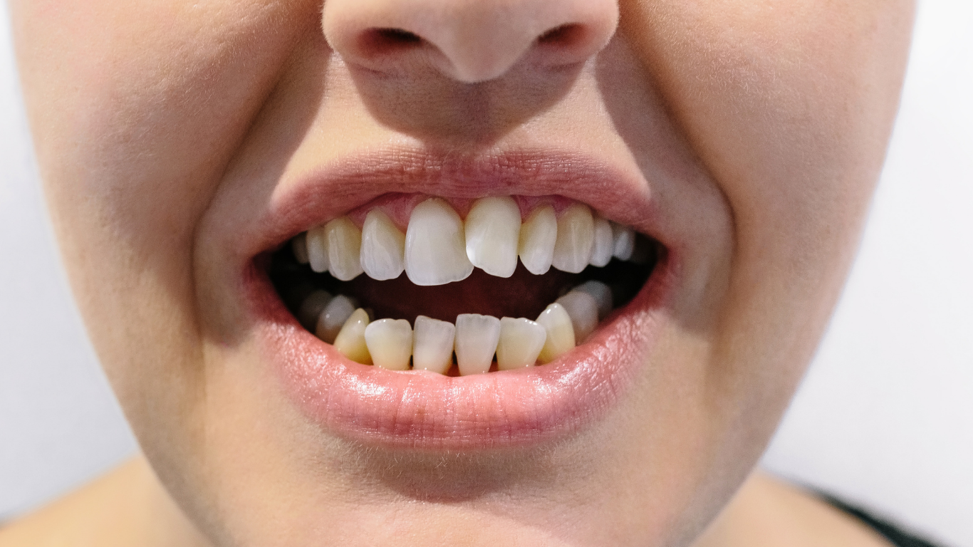 Apiñamiento dental con dientes desalineados que requieren tratamiento de ortodoncia