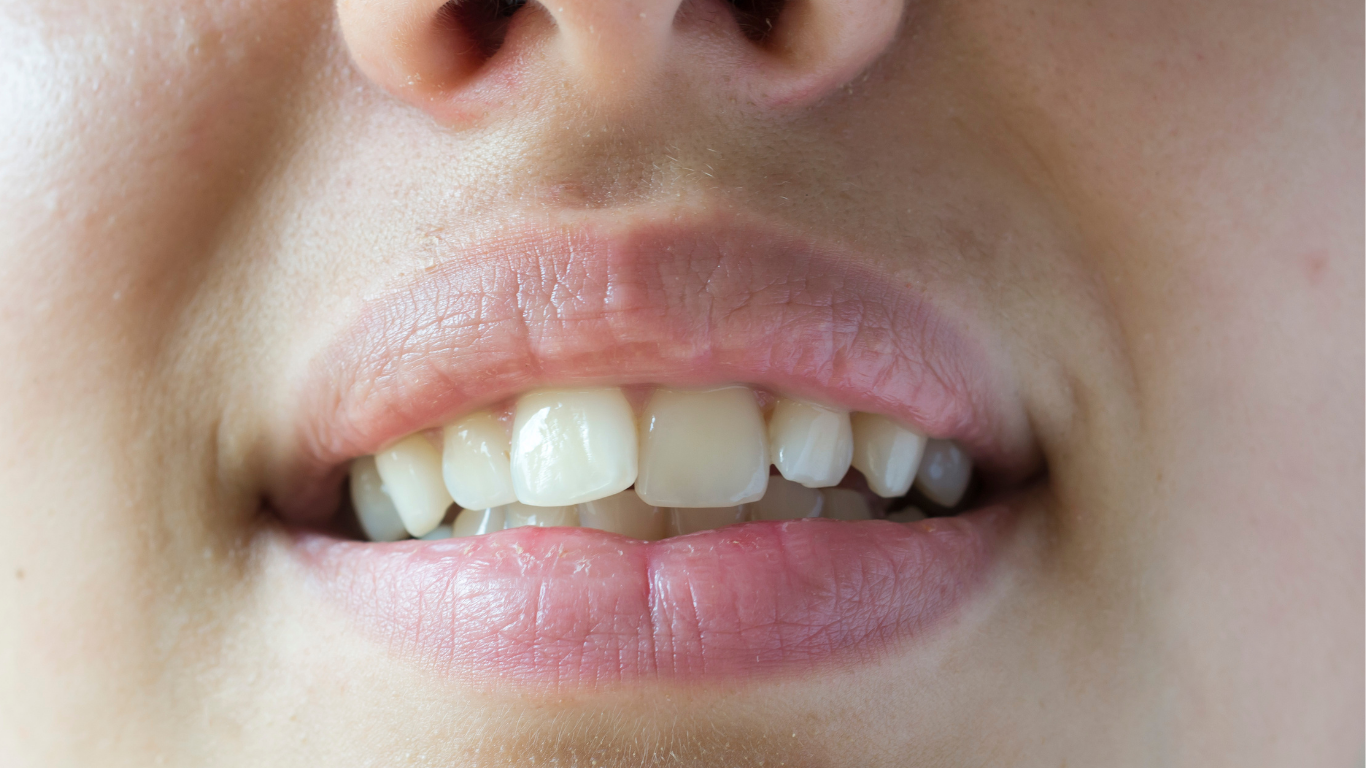 Apiñamiento dental con dientes desalineados que requieren tratamiento de ortodoncia