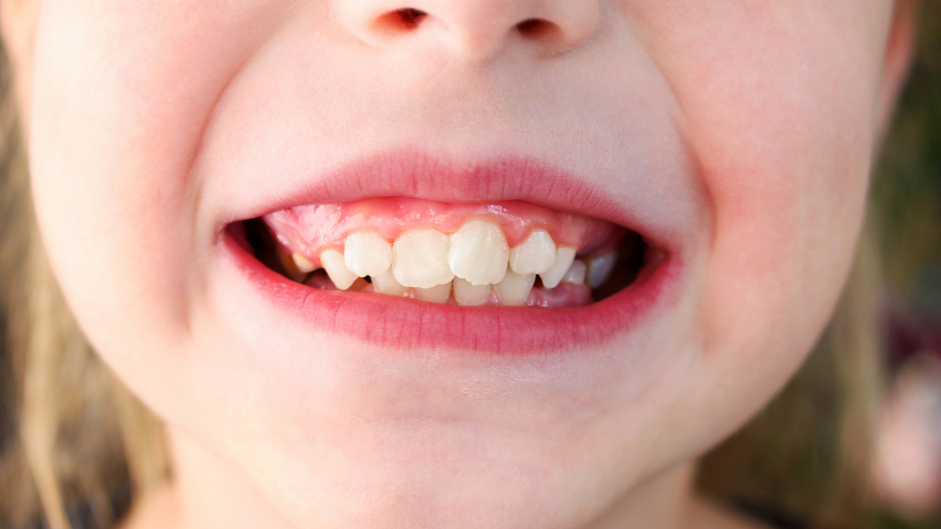 Apiñamiento dental con dientes desalineados que requieren tratamiento de ortodoncia