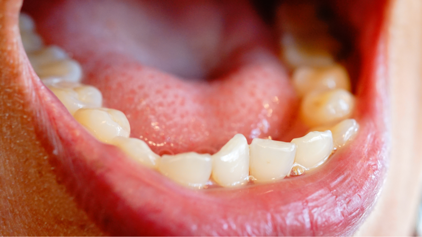 Apiñamiento dental con dientes desalineados que requieren tratamiento de ortodoncia