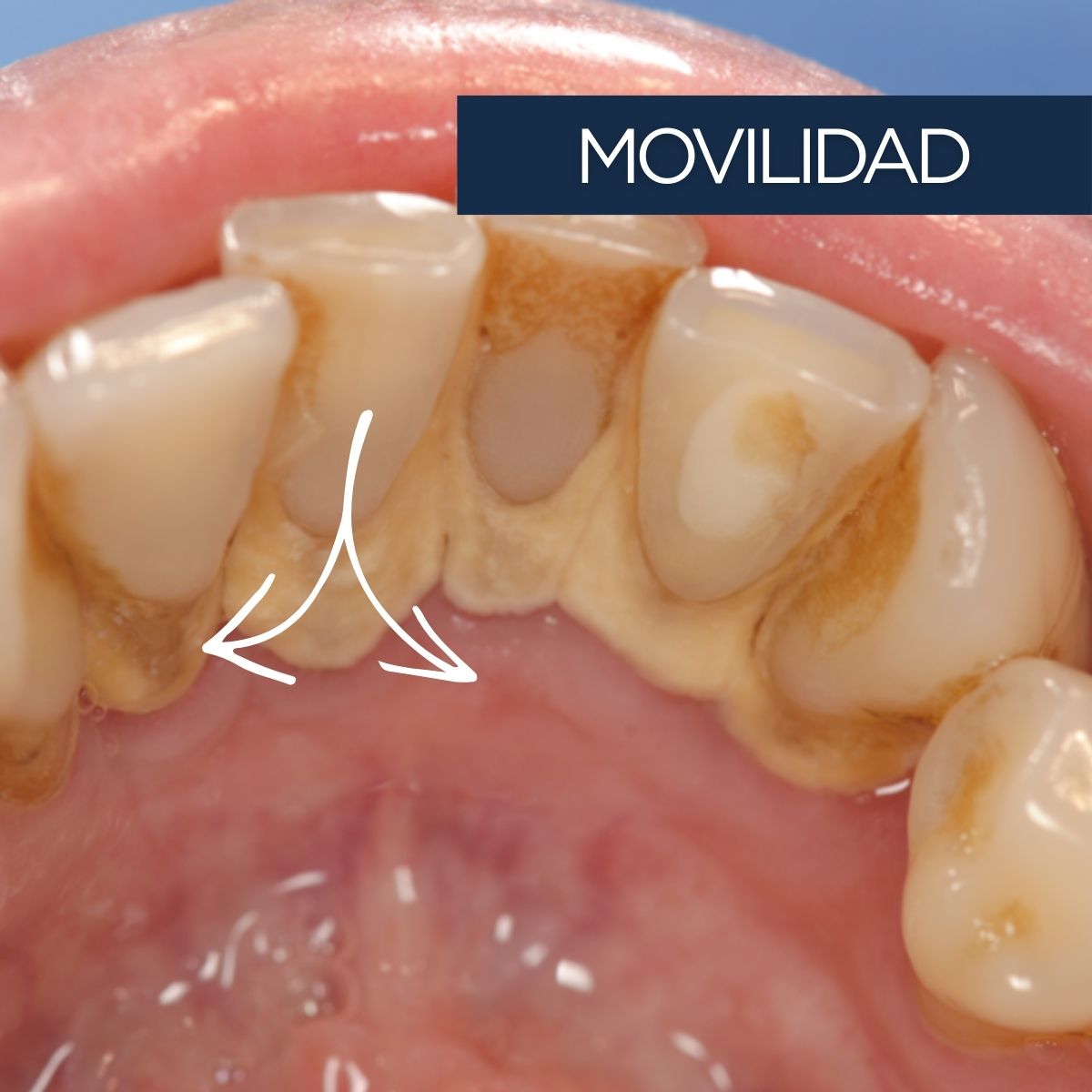 Movilidad dental en dientes inferiores por enfermedad periodontal avanzada