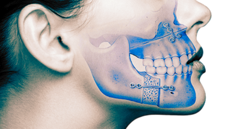 Cirugía ortognática para corrección de la posición de los maxilares y la mordida