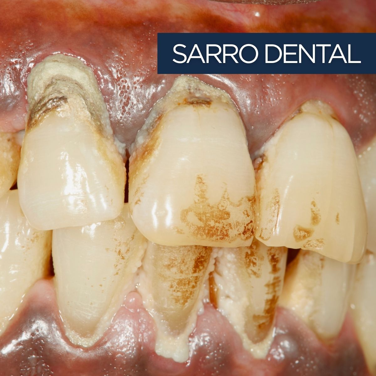 Sarro dental acumulado en dientes por enfermedad periodontal en paciente adulto