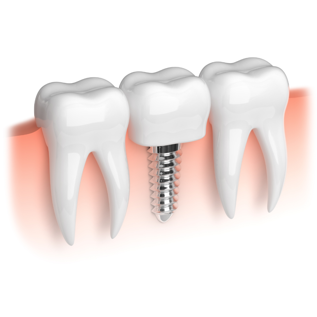 REPRESENTACION GRAFICA DE UN IMPLANTE DENTAL
